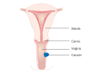 Stage 2 vaginal cancer