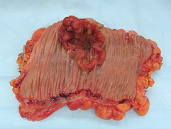 Intestinal polyp in resected segment of colon.