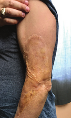 A large burn scar on a man's arm