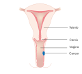 Stage 1 vaginal cancer