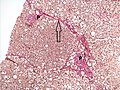 Histopathology of steatohepatitis with moderate fibrosis, with thin fibrous bridges (Van Gieson's stain)[92]