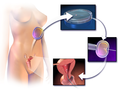 Thumbnail for Assisted reproductive technology