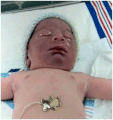 Facial duskiness due to tight nuchal cord