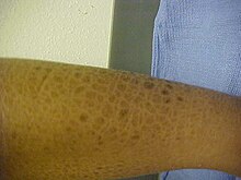 Thick, fish-like scales on an adult lower leg
