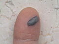 My finger. Used on Blood blister page. My blister was the original and the best!