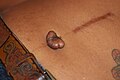 Well healed midline scar of surgery, with keloid forming in the navel area following piercing