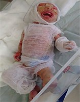 An infant with Harlequin ichthyosis covered in sterile gauze.