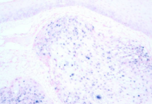 Image of human papilloma virus associated oropharyngeal cancer, under a microscope. The tissue has been stained to show the presence of the virus by in situ hybridisation